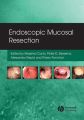 Endoscopic Mucosal Resection