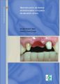 Reconstruccion de dientes endodonciados